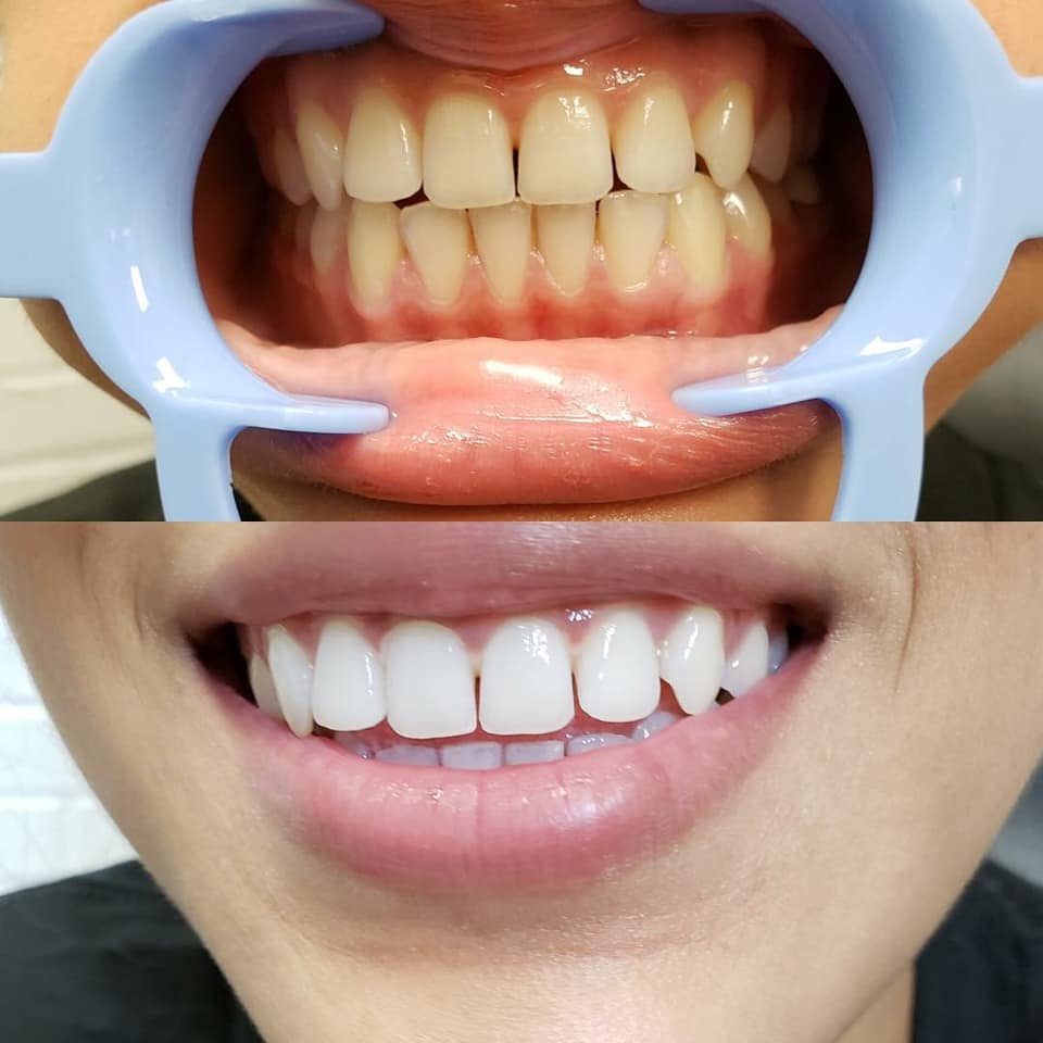 Before and After