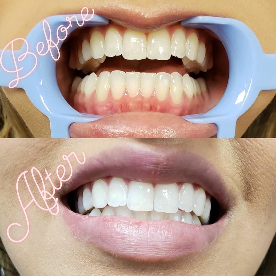 Before and After