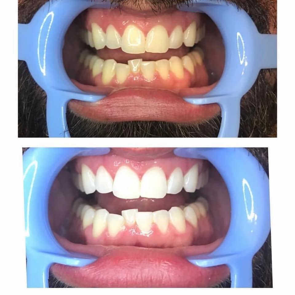 Before and After
